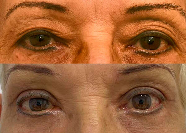 blefaroplastia superior e inferior