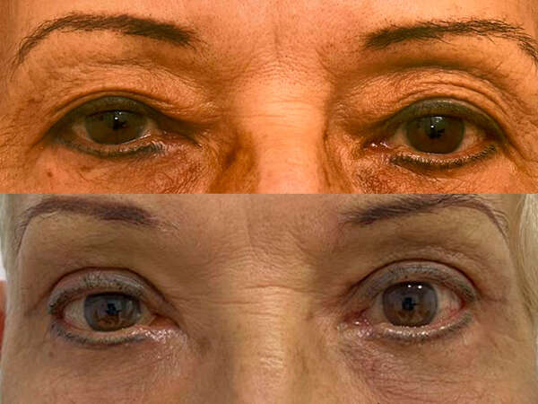 blefaroplastia superior e inferior