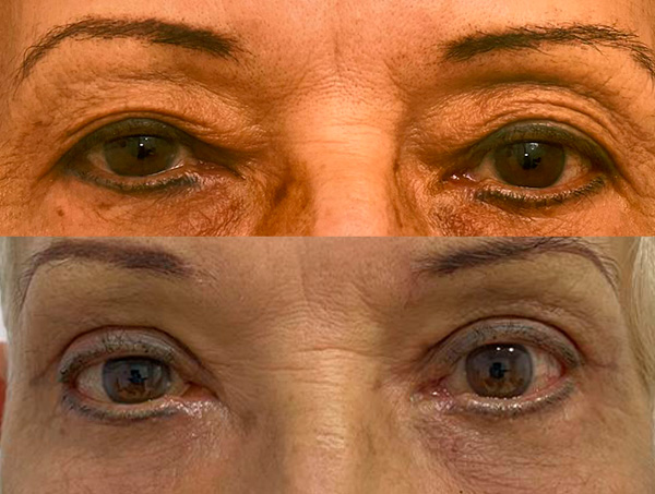 blefaroplastia superior e inferior