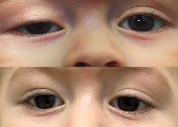 Corrección de ptosis palpebral congenita ojo derecho