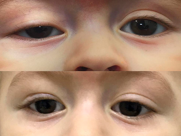 Corrección de ptosis palpebral congenita ojo derecho