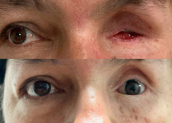 Rehabilitación de la cavidad anoftálmica del ojo izquierdo