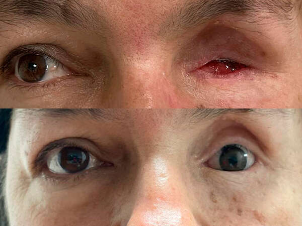 Rehabilitación de la cavidad anoftálmica del ojo izquierdo