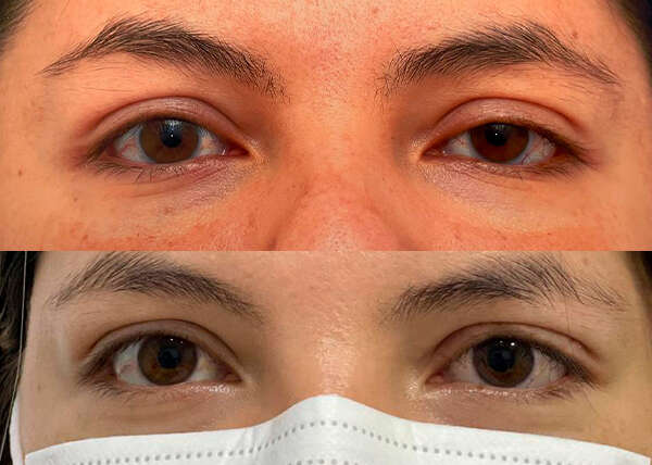 Ptosis palpebral ojo izquierdo EN ADULTOS