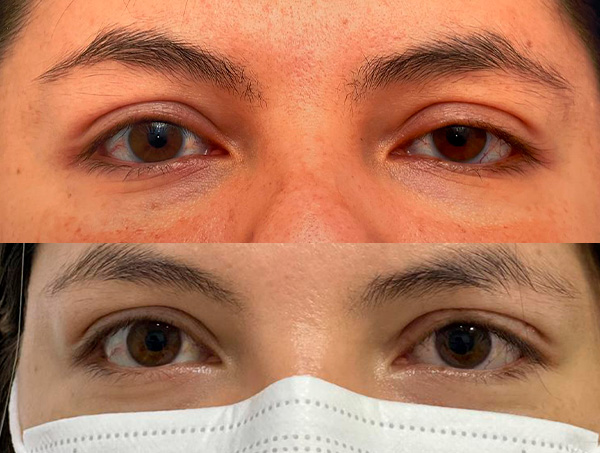 Ptosis palpebral ojo izquierdo EN ADULTOS