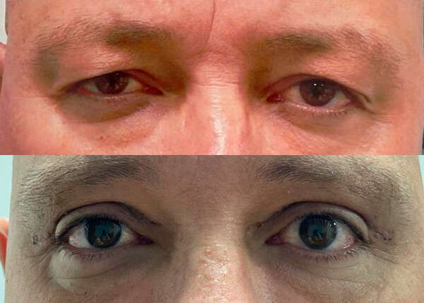 blefaroplastia superior
